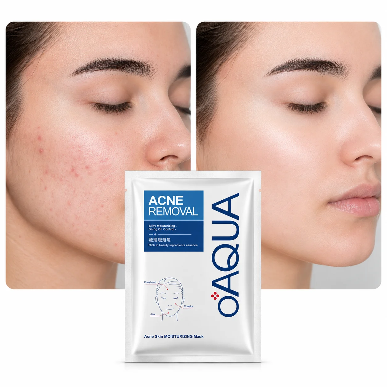 ماسک صورت مرطوب کننده و کنترل کننده چربی بایوآکوا مدل Acne Removal - تصویر 2